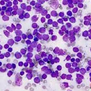 Acute Lymphoblastic Leukemia Market Report: Epidemiology, Trends and Forecast to (2023-2033)