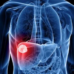 Advanced Liver Cancer Market Research | 2024-2034