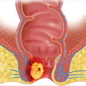 Anal Cancer Market Share, Epidemiology, Analysis & Trends 2023-2033