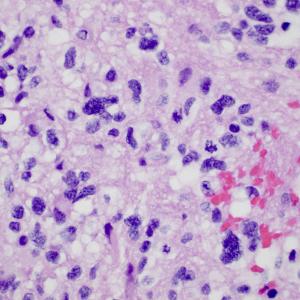 Anaplastic Astrocytoma Market Share, Epidemiology, Analysis & Trends 2024-2034