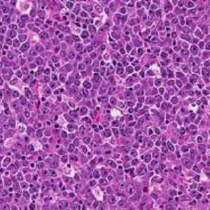 Diffuse Large B-cell Lymphoma (DLBCL) Market Research | 2023-2033