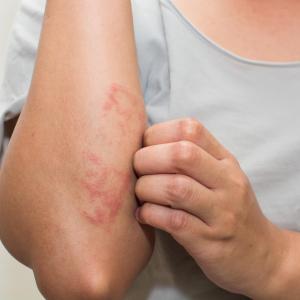 Eczema Market: Epidemiology, Size, Share, Analysis and Forecast till (2024-2034)