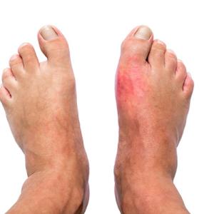 Gout Market Report: Epidemiology, Industry Trends, Share, Size, Demand (2024-2034)