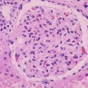 IgA Nephropathy (IgAN) Market Share 2023 | Forecast till 2033