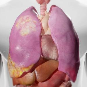 Mesothelioma Market Size and Growth Rate Analysis for 2023-2033| by IMARC Group