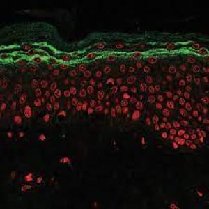 Netherton Syndrome Market Report: Epidemiology, Industry Trends, Share, Size, Demand (2023-2033)