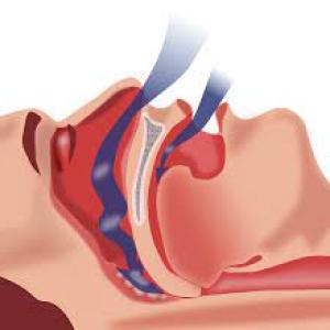 Obstructive Sleep Apnea Market Size, 2023 Analysis, Industry Trends and Forecasts to 2033