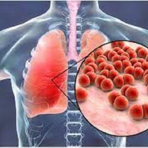 Pneumonia Market: Epidemiology, Trends, Demand, Share, Size (2023-2033)