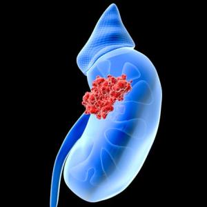 Urothelial Carcinoma Market Share 2023 | Forecast till 2033