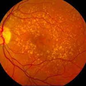 Wet Age-Related Macular Degeneration (Wet AMD) Market Share 2023 | Forecast till 2033