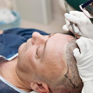 Are Hair Transplant Scars Permanent, or Can They Be Removed?