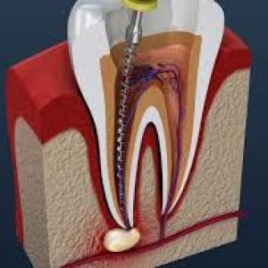 The Root Canal Process Explained: Step-by-Step Guide