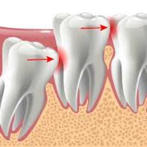 Wisdom Teeth and TMJ Disorders: Is There a Connection?