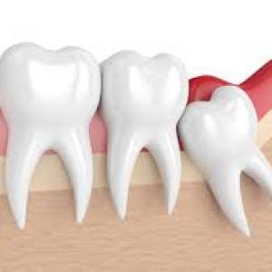 Nutrition After Wisdom Tooth Extraction: Foods to Eat and Avoid