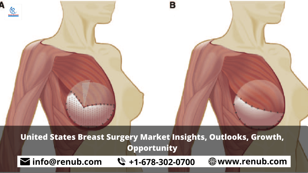 United States Breast Surgery Market Insights, Outlooks, Growth, Opportunity