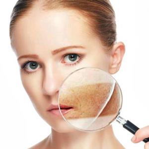 hyperpigmentation disorders treatment Market to grow at a CAGR of 7.1% From 2018 to 2023