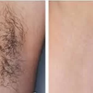 Laser tattoo removal