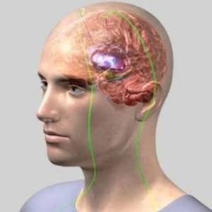 Brain Pacemaker for Parkinsons’: Contact the Top DBS Surgeon in Kolkata, India