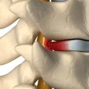 Consult a Top Neuro Spine Surgeon in Kolkata for Disc Replacement Surgery in India