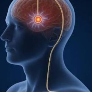 DBS for Advanced Parkinsons' Disease: Brain Pacemaker Surgery by Expert DBS Surgeon
