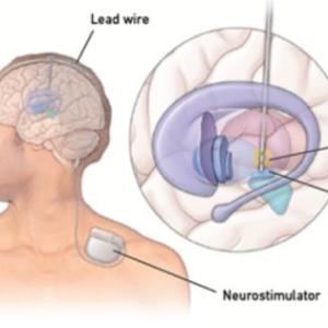 Deep Brain Stimulation (DBS) in Kolkata: A Hope for Advanced Parkinson's Patients