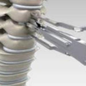 Disc Replacement India: Cervical Disc Replacement Surgery in Kolkata, India