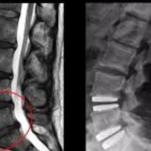 Disc Replacement India: Consult the Best Cervical Spine Surgeon in India