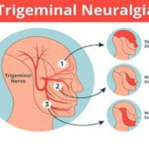 Effective Trigeminal Neuralgia Treatment in Kolkata: Compassionate Care, Modern Solutions