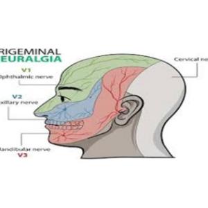Kolkata's Renowned Neurosurgeons: Pioneering Trigeminal Neuralgia Treatment