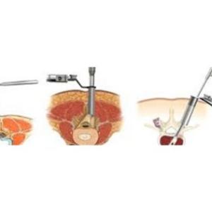 Kolkata's Top Spine Surgeons: Expertise in Minimal Access Spine Surgery for Optimal Results