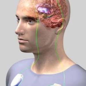 Life After DBS Surgery: DBS Surgeon in Kolkata, India