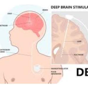 Life after DBS Surgery: DBS for Advanced Parkinsons’ Disease India Care and Treatment