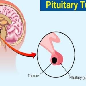 Living With a Pituitary Tumor: Managing Symptoms and Finding Support in Kolkata