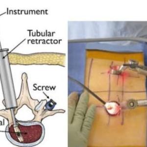 Meet a Minimally Invasive Spine Surgeon in India: Top Spine Surgeon in Kolkata