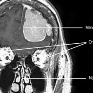 Meningioma Brain Tumor Treatment in Kolkata: A Comprehensive Guide