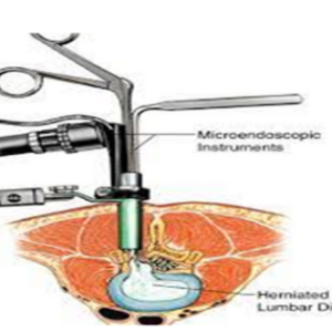 Minimally Invasive Discectomy: A Revolutionary Procedure for Herniated Discs