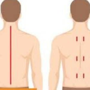 Minimally Invasive Spine Surgery Vs Traditional Open Surgery