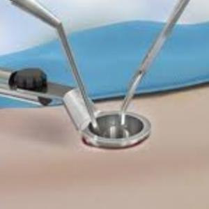 Minimally Invasive Spine Surgery in India for Faster Recovery