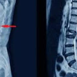 Osteoporotic Vertebral Fractures: How India’s Top Spine Surgeons Are Making a Difference
