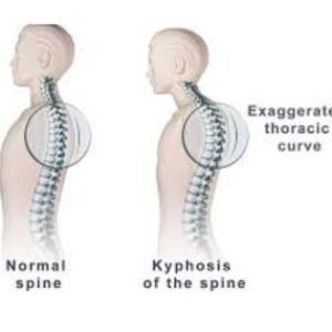 Spinal Deformity Correction in Kolkata: Expertise of Leading Spine Surgeons
