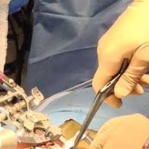 Spinal Tumor Treatment in Kolkata: Consult Top Spine Neurosurgeon in India
