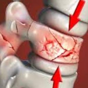 Spine Fracture Treatment in Kolkata: Vertebroplasty and Kyphoplasty Recovery Time in the Elderly
