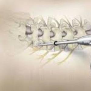 Spine Surgery in India: Quick Recovery in Minimally Invasive Spine Surgery