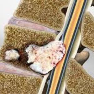 Spine Tumor Causes, Symptoms & Treatment in Kolkata, India