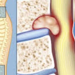 Spine Tumor Diagnosis and Treatment in Kolkata: A Comprehensive Guide