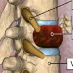 Spine Tumor Surgery in India: Consult Top Spine Neurosurgeon in Kolkata, India