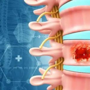 Spine Tumor Surgery in India: Meet the Top Spine Specialist in India
