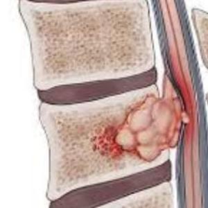 Spine Tumors in Kolkata: Symptoms, Diagnosis and Treatment Options