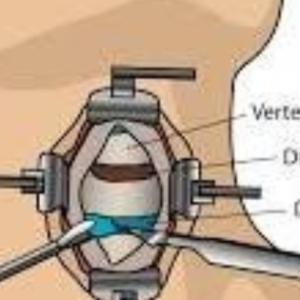 The Importance of Expertise in Cervical Spine Surgery in Kolkata: Why It Matters