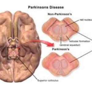Top Neurosurgeons in India: DBS Surgery for Parkinsons’ Disease Expertise